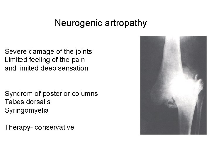Neurogenic artropathy Severe damage of the joints Limited feeling of the pain and limited