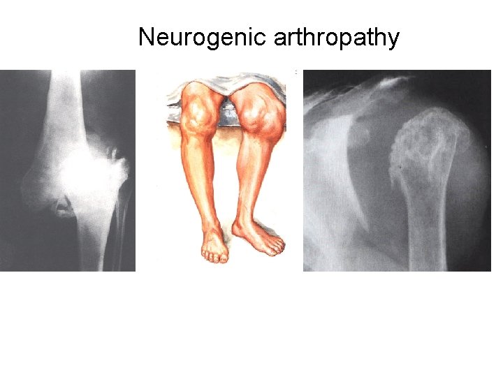 Neurogenic arthropathy 