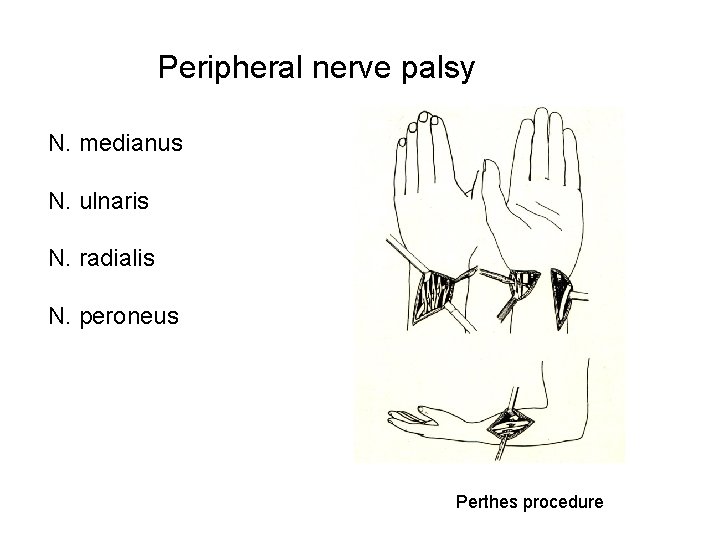 Peripheral nerve palsy N. medianus N. ulnaris N. radialis N. peroneus Perthes procedure 