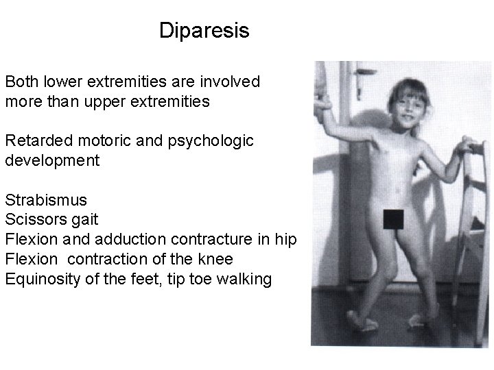 Diparesis Both lower extremities are involved more than upper extremities Retarded motoric and psychologic