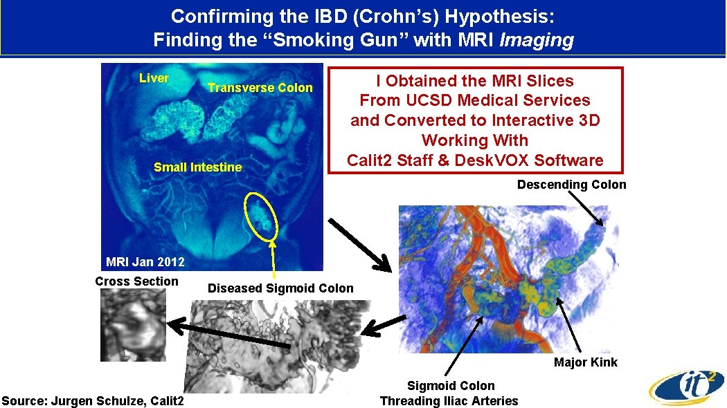 Confirming the IBD (Crohn’s) Hypothesis: Finding the “Smoking Gun” with MRI Imaging Liver Transverse