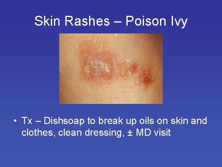 Skin Rashes – Poison Ivy • Tx – Dishsoap to break up oils on