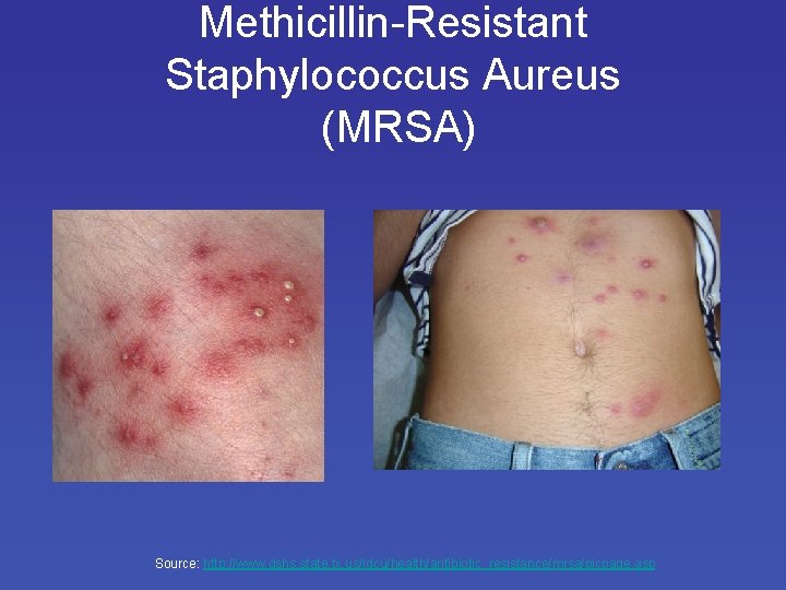 Methicillin-Resistant Staphylococcus Aureus (MRSA) Source: http: //www. dshs. state. tx. us/idcu/health/antibiotic_resistance/mrsa/picpage. asp 
