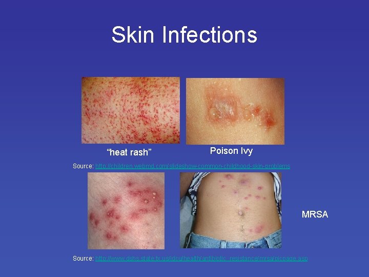 Skin Infections “heat rash” Poison Ivy Source: http: //children. webmd. com/slideshow-common-childhood-skin-problems MRSA Source: http: