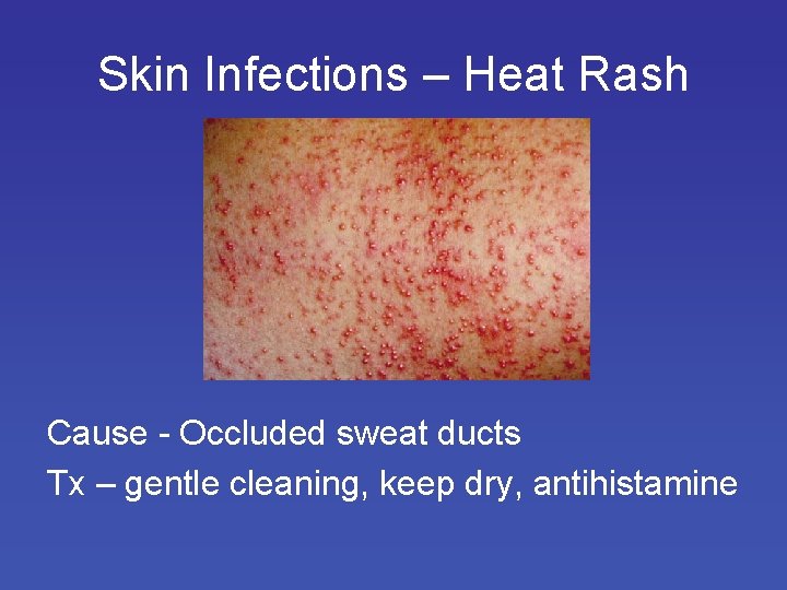 Skin Infections – Heat Rash Cause - Occluded sweat ducts Tx – gentle cleaning,