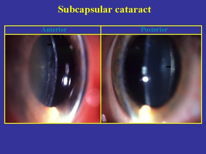 Subcapsular cataract Anterior Posterior 