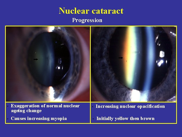 Nuclear cataract Progression • • Exaggeration of normal nuclear ageing change • Increasing nuclear