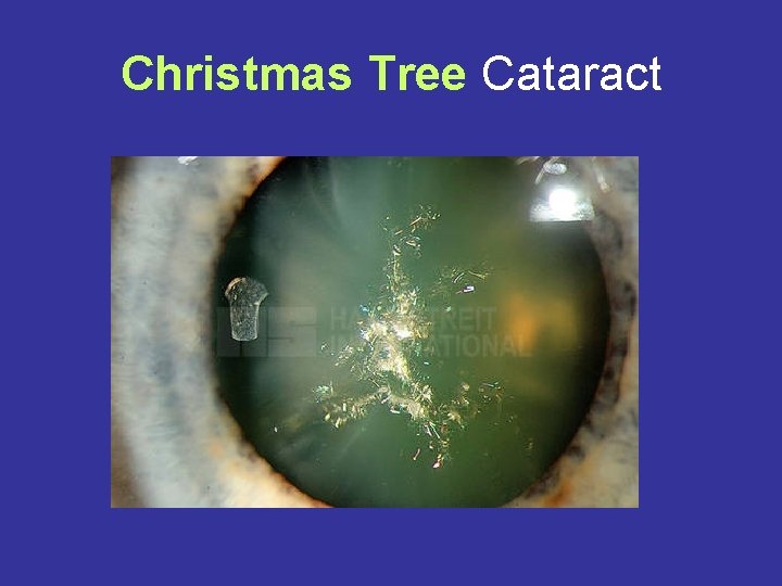 Christmas Tree Cataract 