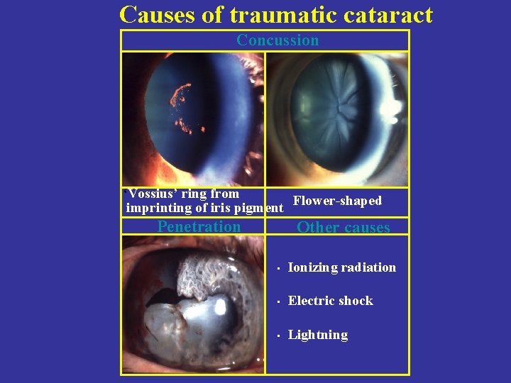 Causes of traumatic cataract Concussion ‘Vossius’ ring from imprinting of iris pigment Flower-shaped Penetration