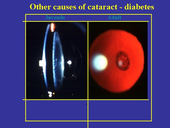 Other causes of cataract - diabetes Juvenile • • Adult • 