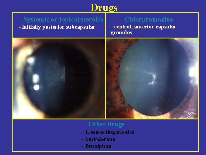 Drugs Systemic or topical steroids - initially posterior subcapsular Chlorpromazine - central, anterior capsular