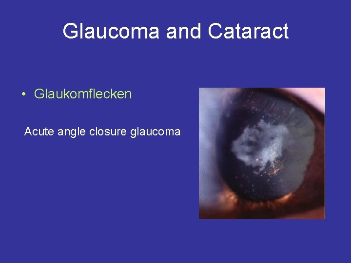 Glaucoma and Cataract • Glaukomflecken Acute angle closure glaucoma 