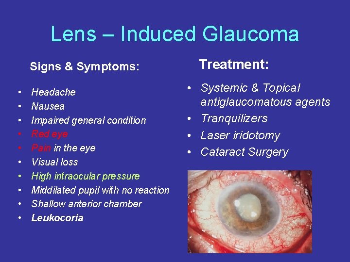 Lens – Induced Glaucoma Signs & Symptoms: • • • Headache Nausea Impaired general
