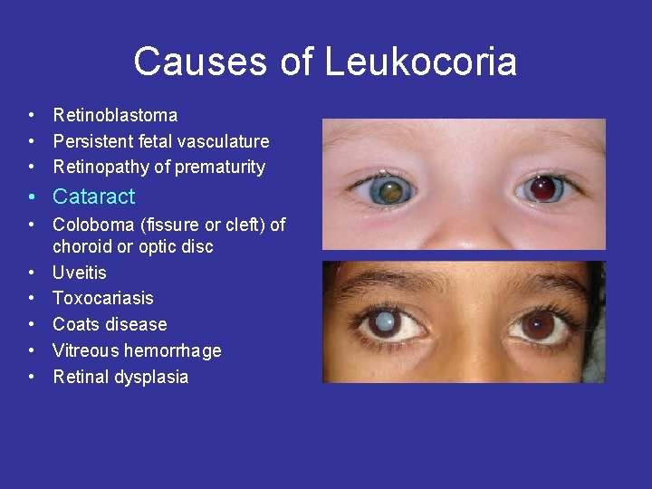 Causes of Leukocoria • Retinoblastoma • Persistent fetal vasculature • Retinopathy of prematurity •
