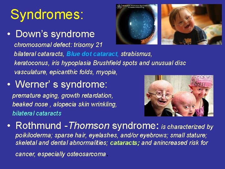 Syndromes: • Down’s syndrome chromosomal defect: trisomy 21 bilateral cataracts, Blue dot cataract, strabismus,