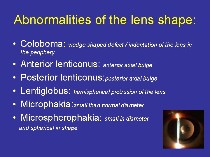 Abnormalities of the lens shape: • Coloboma: wedge shaped defect / indentation of the
