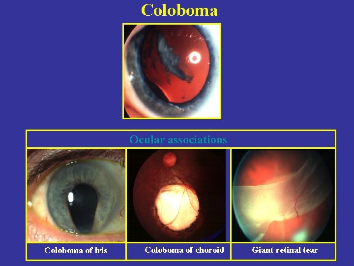 Coloboma Ocular associations Coloboma of iris Coloboma of choroid Giant retinal tear 
