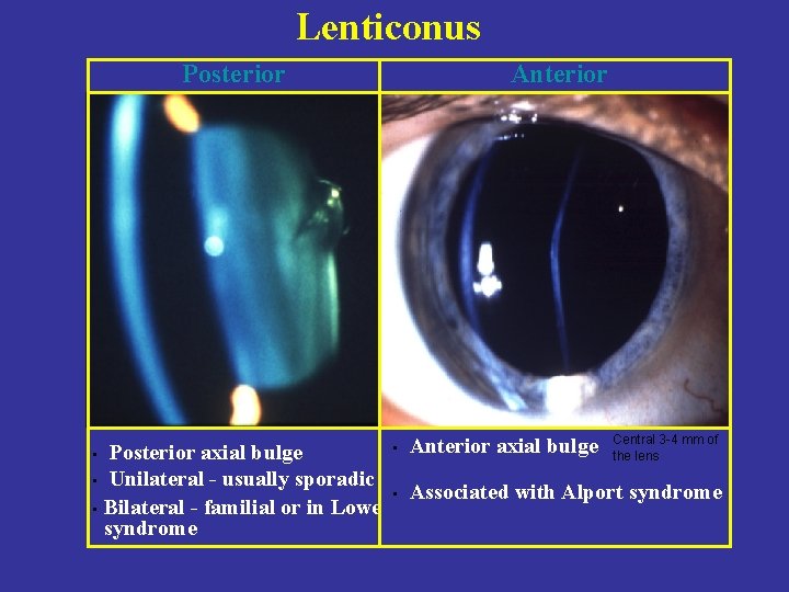 Lenticonus Posterior axial bulge • Unilateral - usually sporadic • Bilateral - familial or