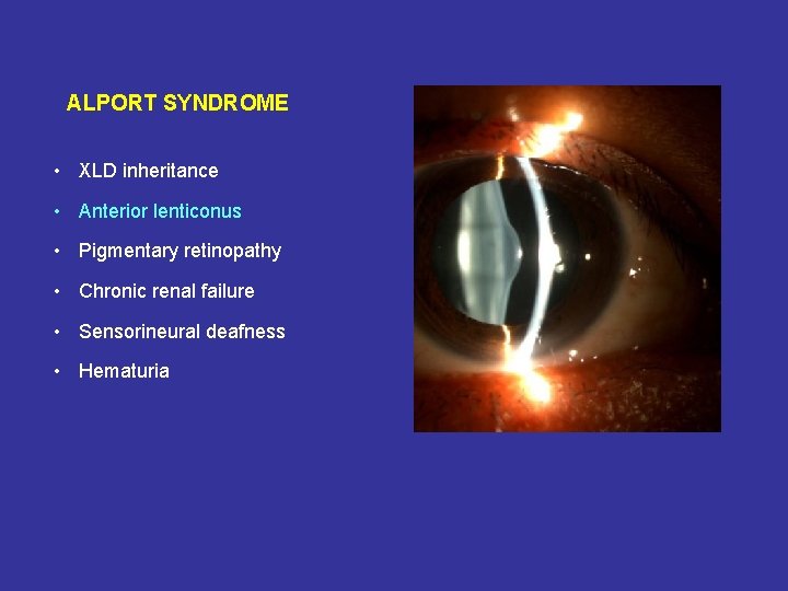 ALPORT SYNDROME • XLD inheritance • Anterior lenticonus • Pigmentary retinopathy • Chronic renal