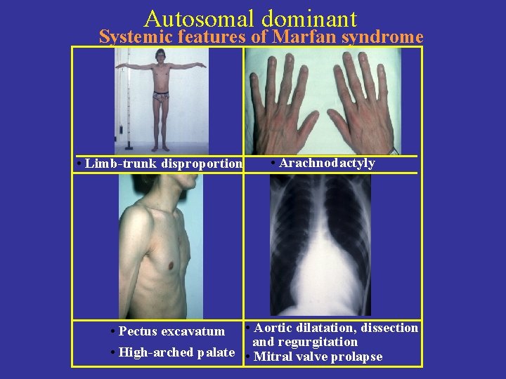 Autosomal dominant Systemic features of Marfan syndrome • Limb-trunk disproportion • Arachnodactyly • Pectus