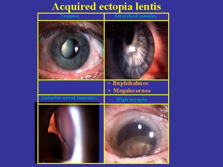 Acquired ectopia lentis Trauma Stretched zonules • Buphthalmos • Megalocornea Anterior uveal tumours High