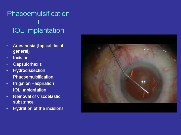 Phacoemulsification + IOL Implantation • • • Anesthesia (topical, local, general) Incision Capsulorhexis Hydrodissection