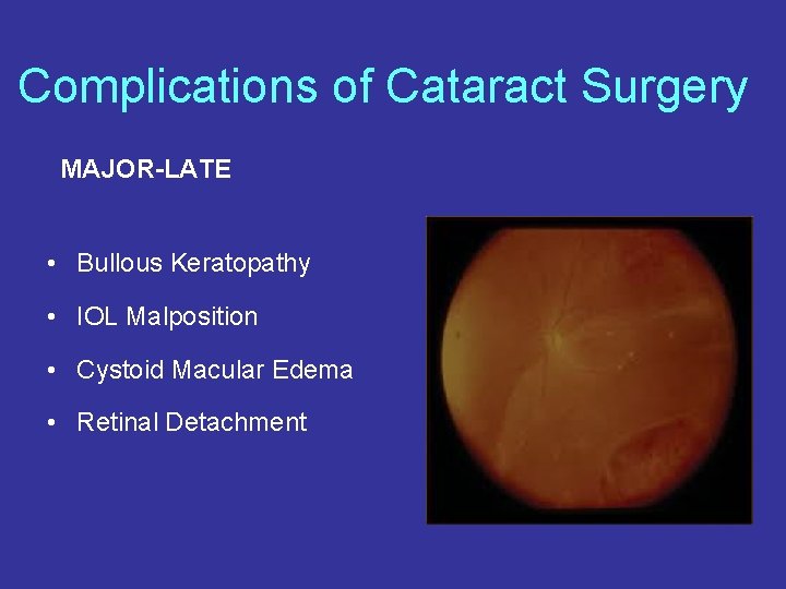 Complications of Cataract Surgery MAJOR-LATE • Bullous Keratopathy • IOL Malposition • Cystoid Macular