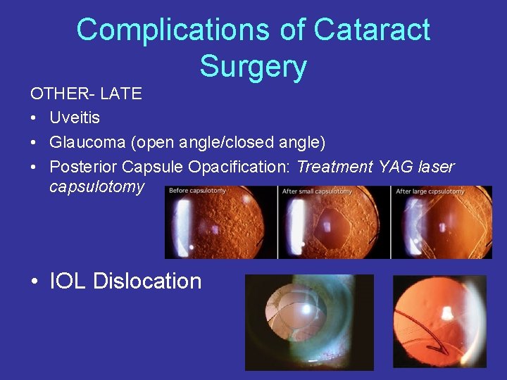 Complications of Cataract Surgery OTHER- LATE • Uveitis • Glaucoma (open angle/closed angle) •