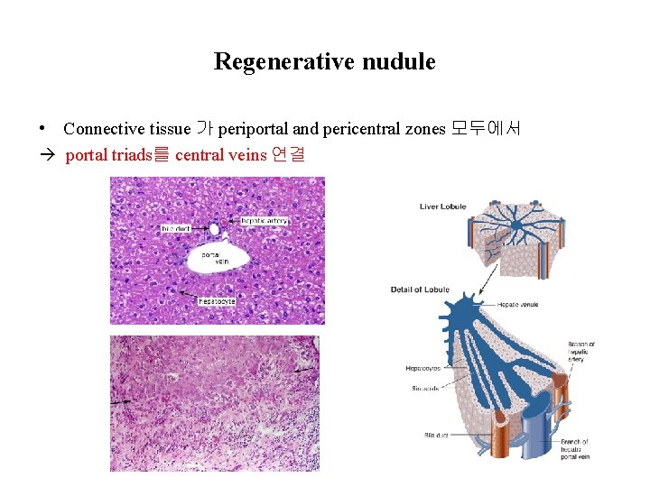 Regenerative nudule • Connective tissue 가 periportal and pericentral zones 모두에서 portal triads를 central