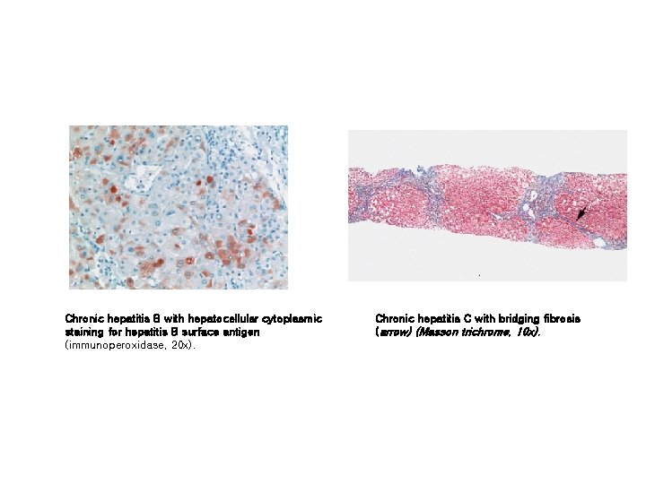 Chronic hepatitis B with hepatocellular cytoplasmic staining for hepatitis B surface antigen (immunoperoxidase, 20