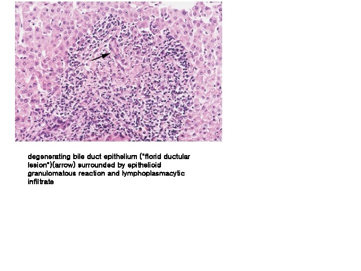 degenerating bile duct epithelium ("florid ductular lesion")(arrow) surrounded by epithelioid granulomatous reaction and lymphoplasmacytic