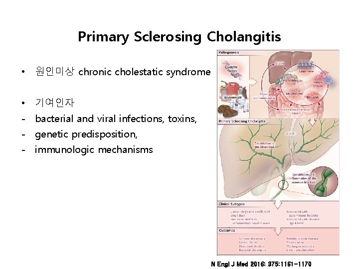 Primary Sclerosing Cholangitis • 원인미상 chronic cholestatic syndrome • 기여인자 - bacterial and viral