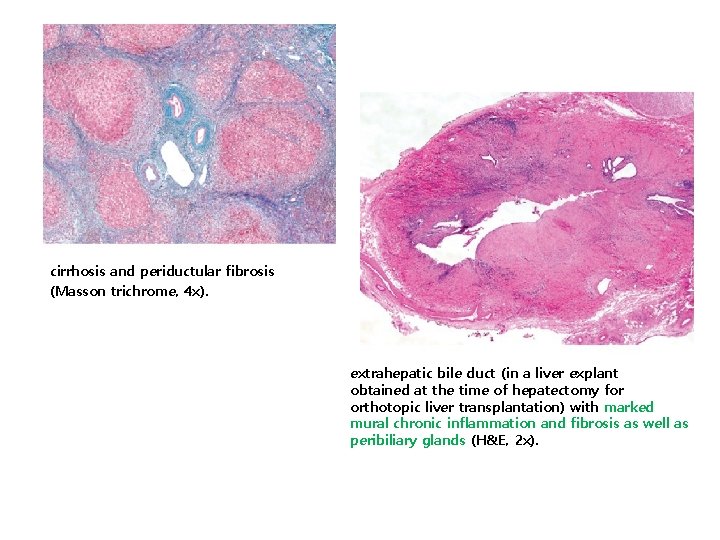 cirrhosis and periductular fibrosis (Masson trichrome, 4 x). extrahepatic bile duct (in a liver