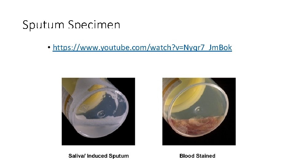 Sputum Specimen • https: //www. youtube. com/watch? v=Nyqr 7_Jm. Bok 