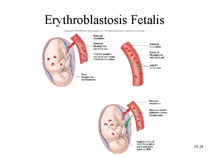 Erythroblastosis Fetalis 19 -24 