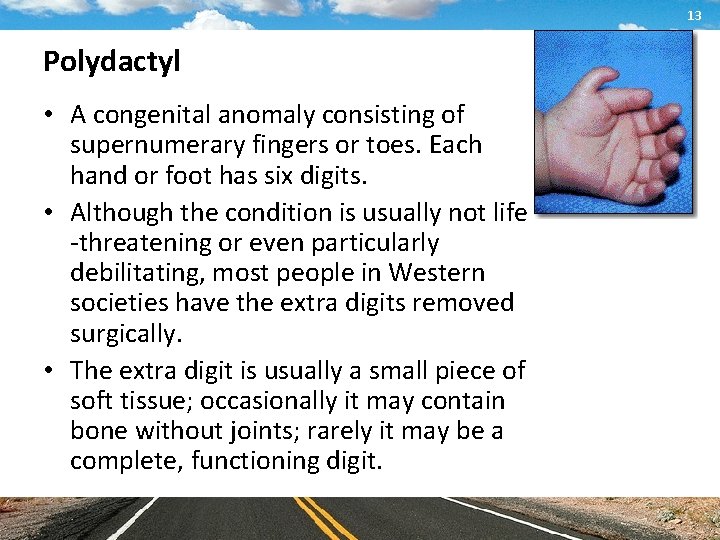 13 Polydactyl • A congenital anomaly consisting of supernumerary fingers or toes. Each hand