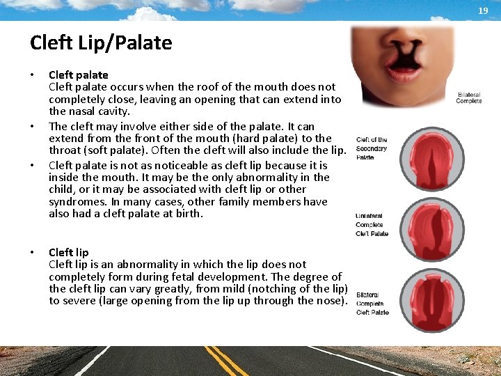 19 Cleft Lip/Palate • • Cleft palate occurs when the roof of the mouth