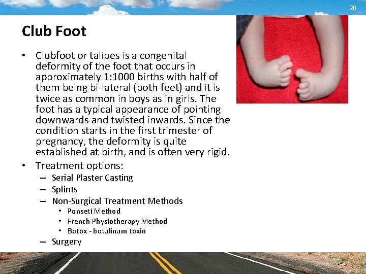 20 Club Foot • Clubfoot or talipes is a congenital deformity of the foot