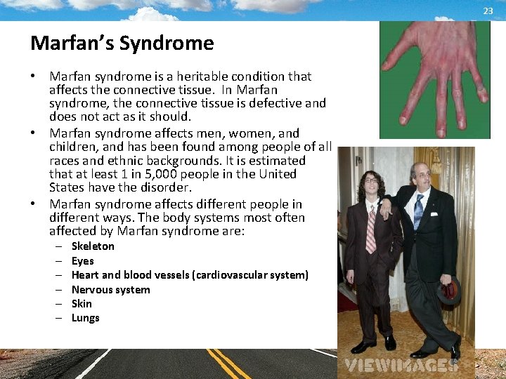 23 Marfan’s Syndrome • Marfan syndrome is a heritable condition that affects the connective