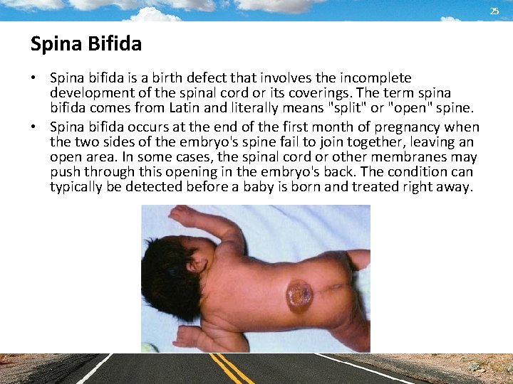 25 Spina Bifida • Spina bifida is a birth defect that involves the incomplete