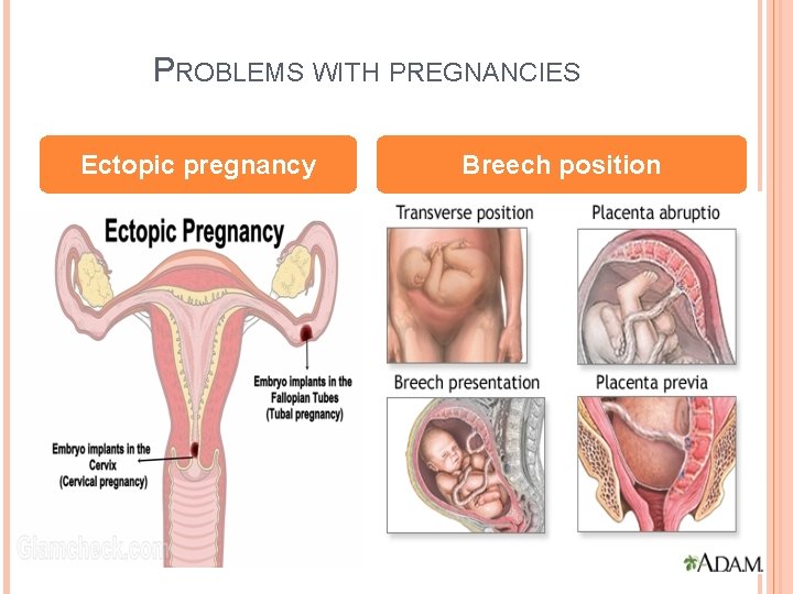 PROBLEMS WITH PREGNANCIES Ectopic pregnancy Breech position 