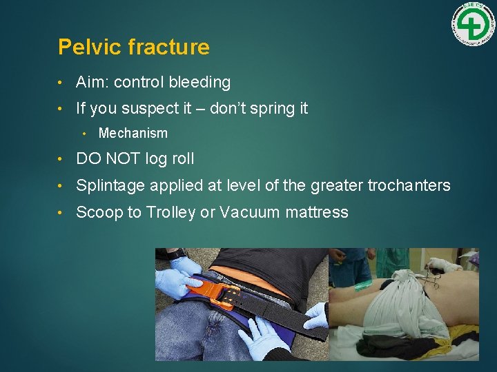 Pelvic fracture • Aim: control bleeding • If you suspect it – don’t spring