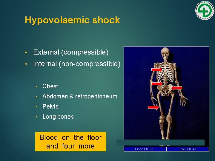 Hypovolaemic shock • External (compressible) • Internal (non-compressible) • Chest • Abdomen & retroperitoneum