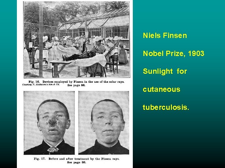 Niels Finsen Nobel Prize, 1903 Sunlight for cutaneous tuberculosis. 