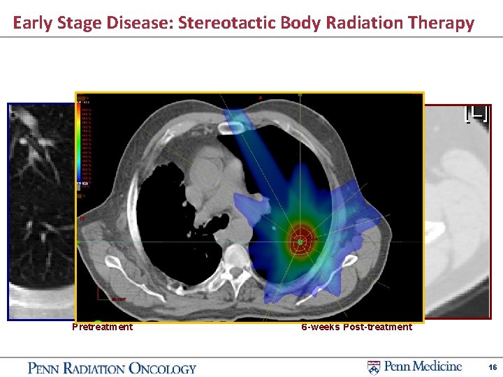 Early Stage Disease: Stereotactic Body Radiation Therapy Pretreatment 6 -weeks Post-treatment 16 