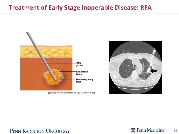 Treatment of Early Stage Inoperable Disease: RFA 21 