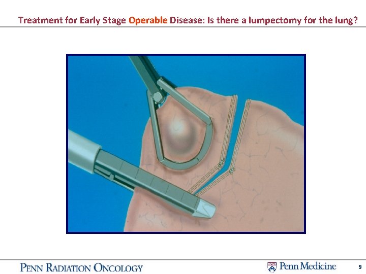 Treatment for Early Stage Operable Disease: Is there a lumpectomy for the lung? 9