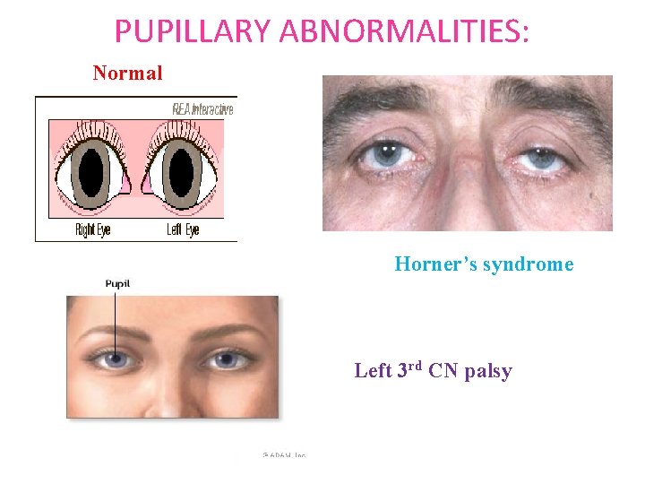 PUPILLARY ABNORMALITIES: Normal Horner’s syndrome Left 3 rd CN palsy 