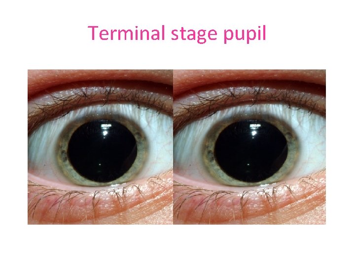 Terminal stage pupil 