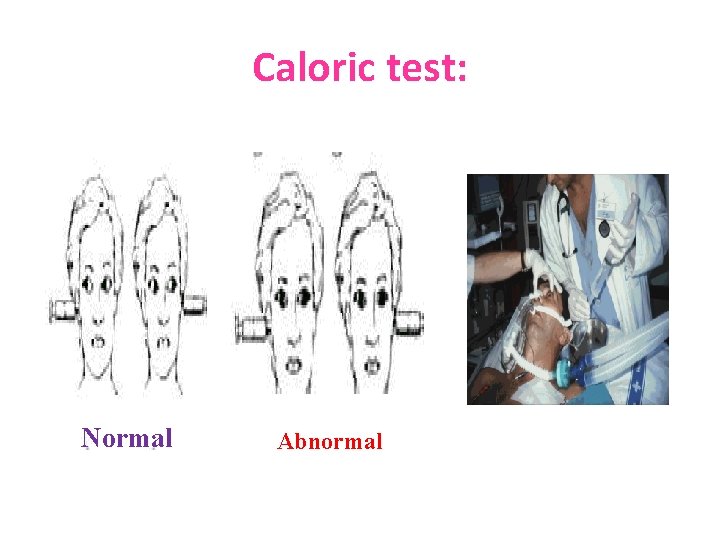 Caloric test: Normal Abnormal 